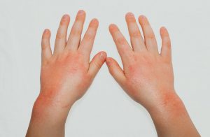 Contact-dermatitis-blisters