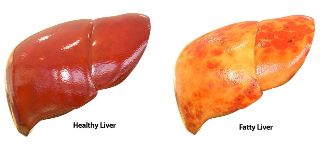 Healthy versus Fatty Liver