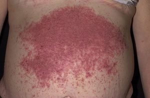 Herpetic dermatitis