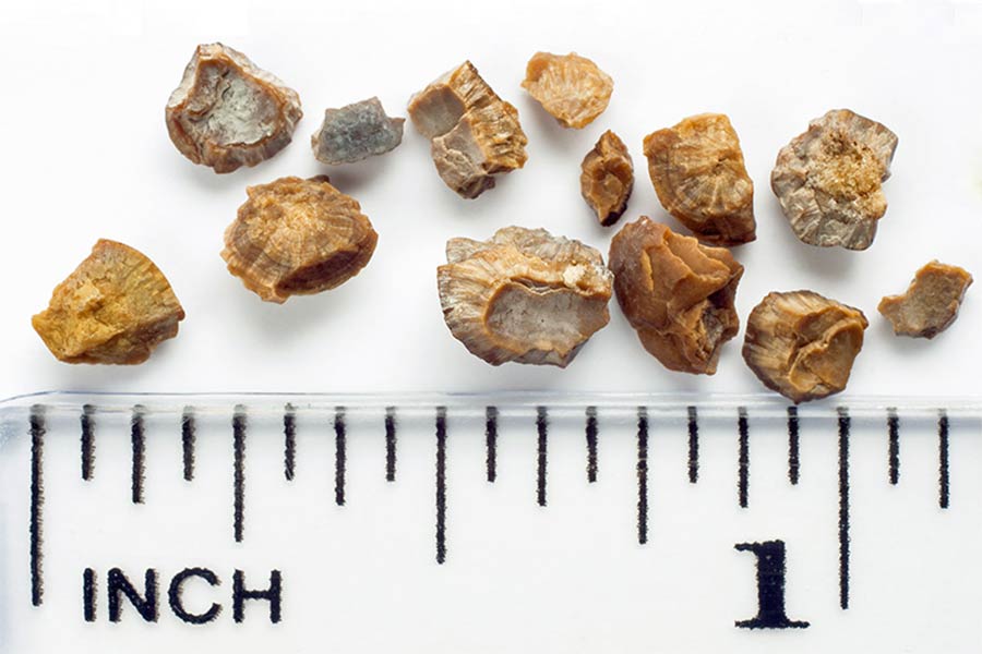 Kidney stone size