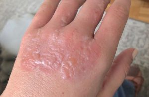 Skin blisters due to burns