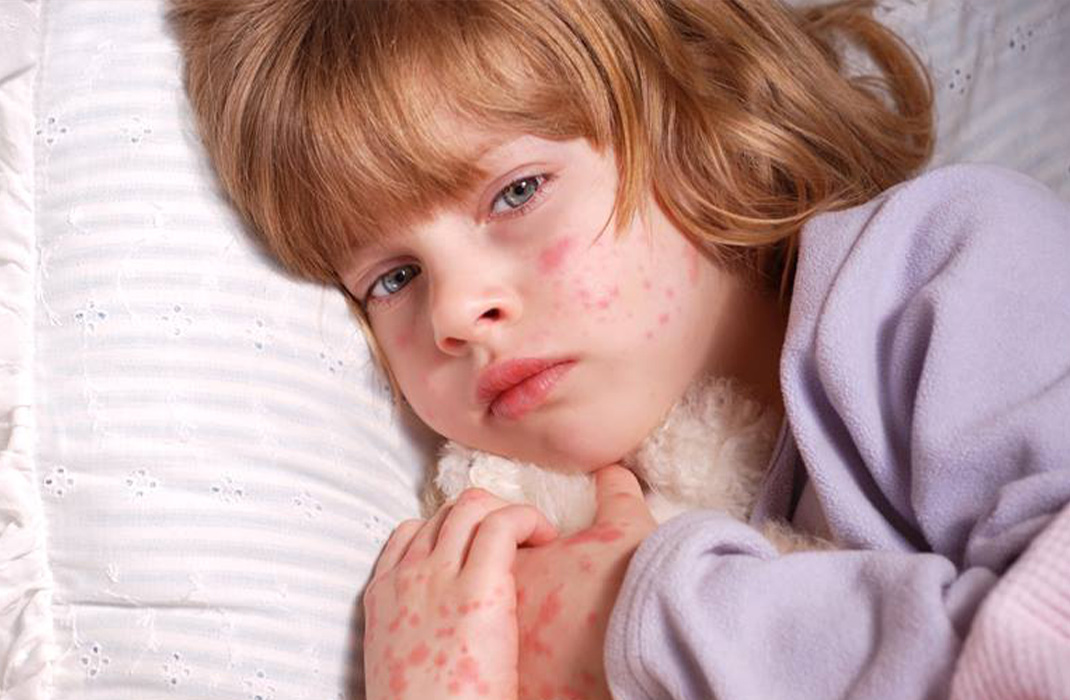 Skin blisters in children