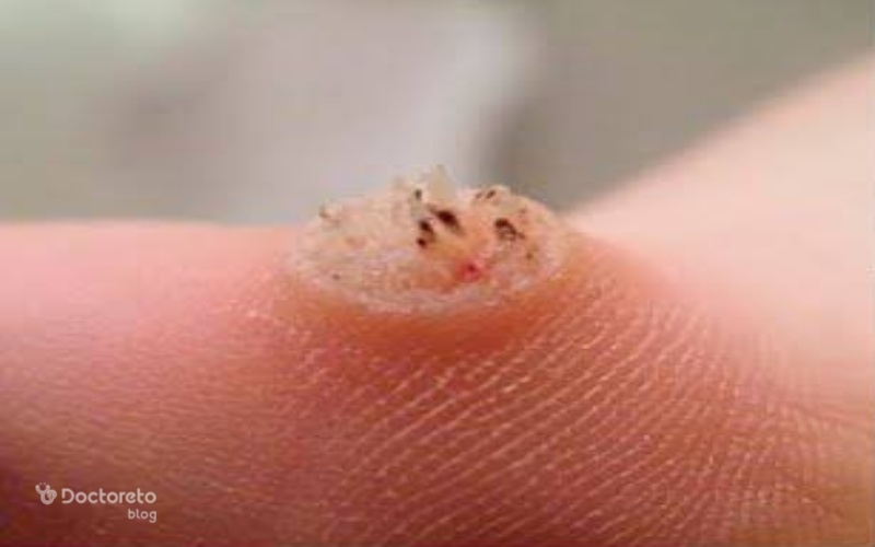 عکس ریشه میخچه پا