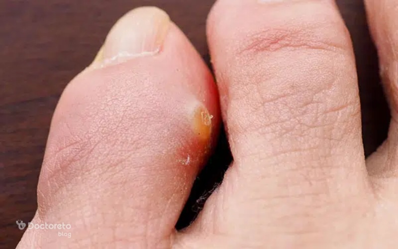 عکس میخچه انگشت