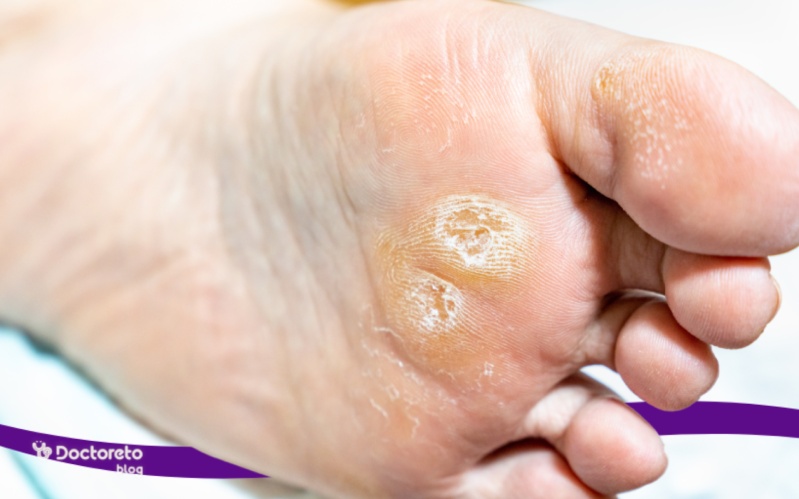میخچه چطور شکل می‌ گیرد و چگونه از آن پیشگیری کنیم؟
