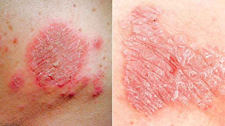 what cause eczema