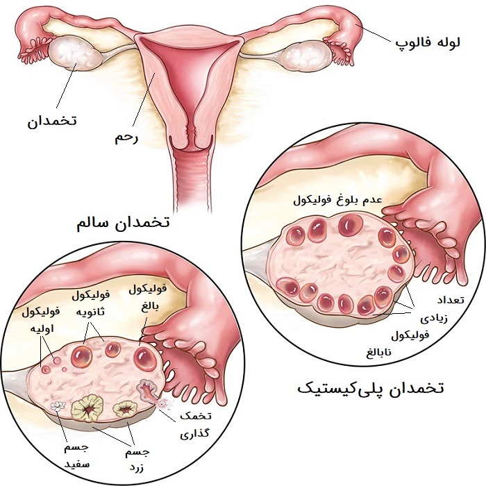 عکس کیست تخمدان