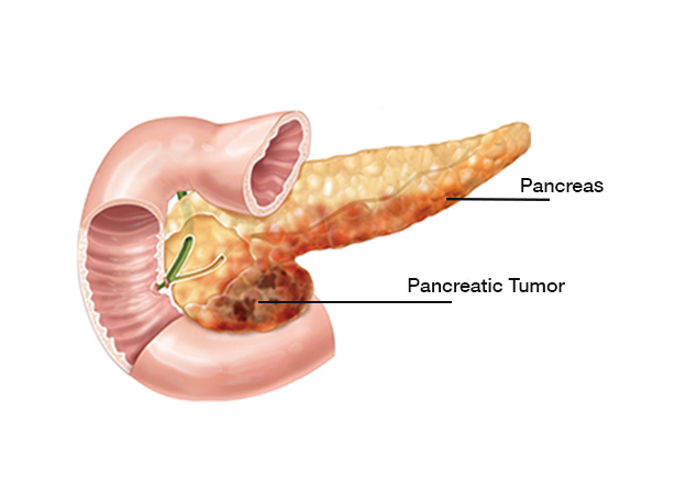 بیماری پانکراس می تواند ایجاد معده درد کند. 
