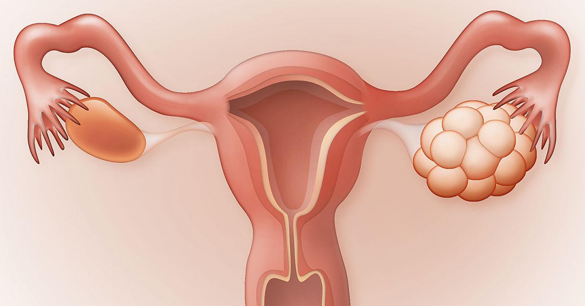 درمان سندروم تخمدان پلی کیستیک از چند طریق انجام می شود.