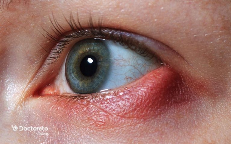 گل مژه چیست و چه علائمی دارد؟