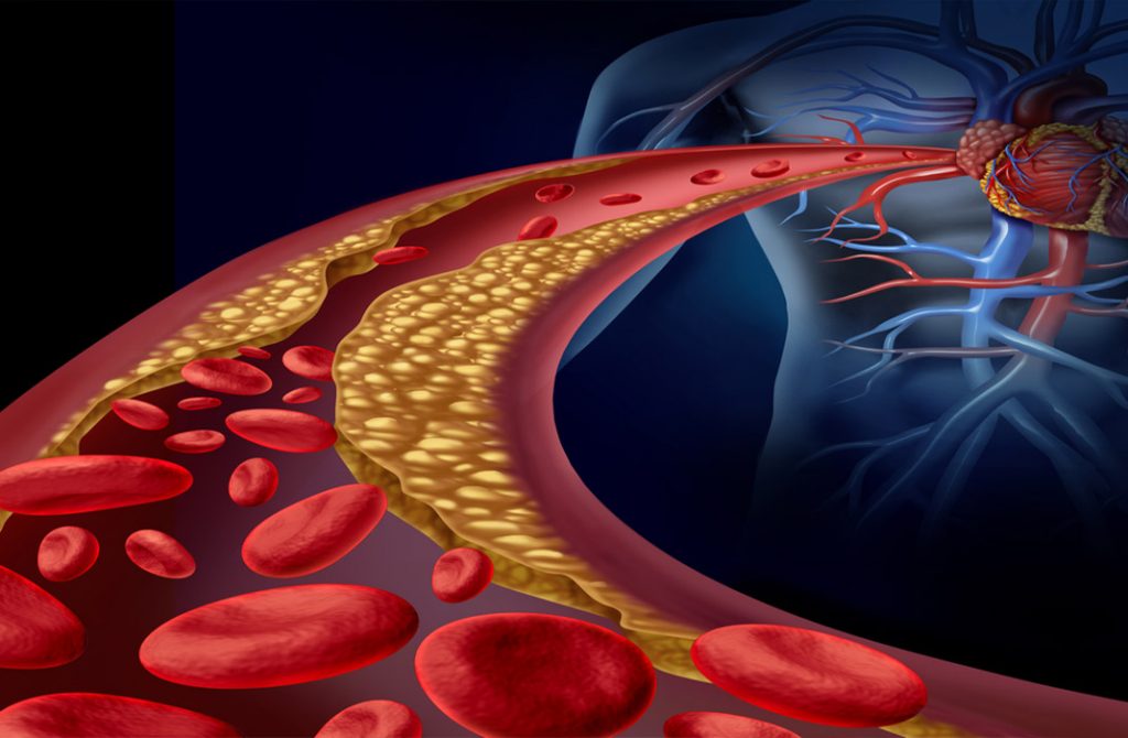 Hyperlipidemia-and-coronary-heart-disease