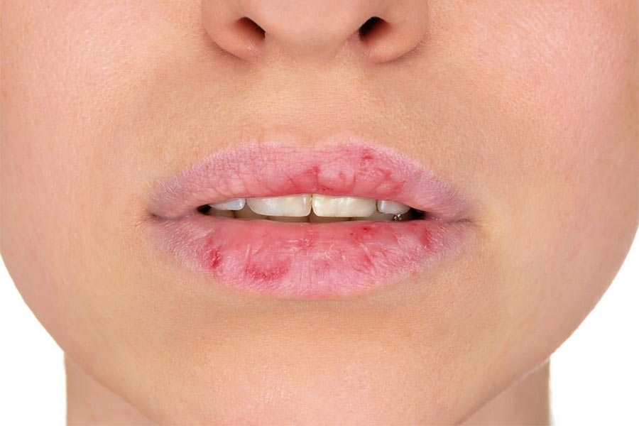 Treatment of dry lips