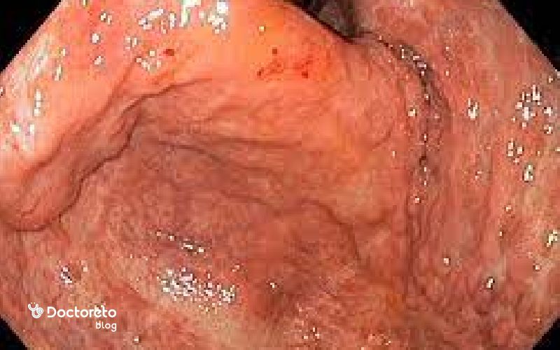 نحوه خواندن جواب اندوسکوپی چگونه است؟