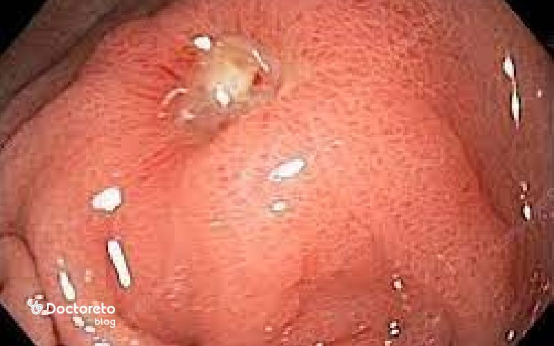 عکس زخم معده در اندوسکوپی