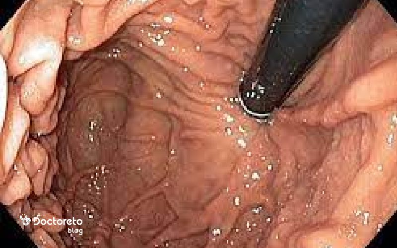 عکس آندوسکوپی معده سالم