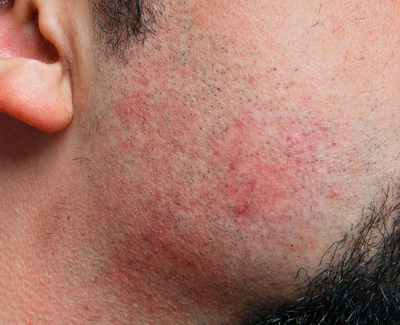 علت سوختگی صورت بعد از شیو کردن چیست؟