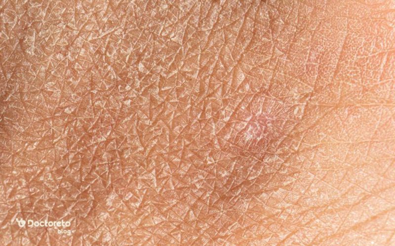 خشکی پوست شدید نشانه چیست؟