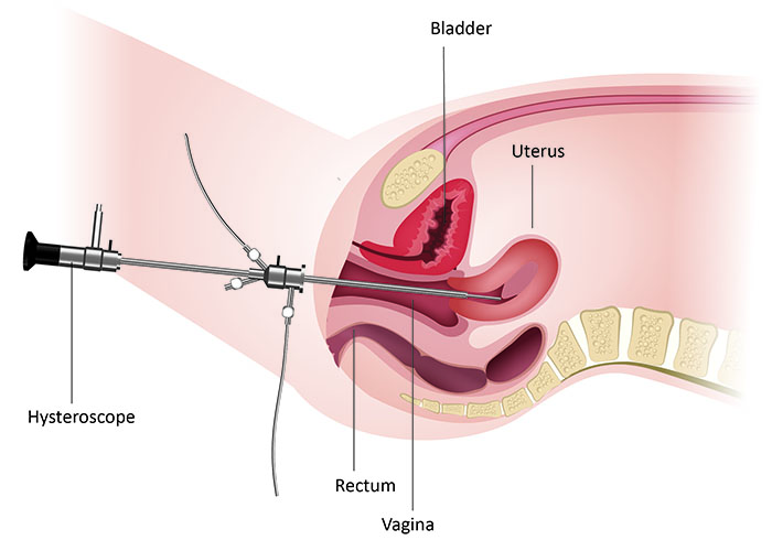 uterine diagnosis