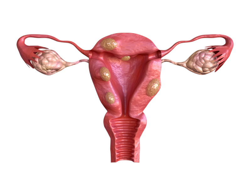 uterine fibroids and low abdominal pain afetr sex