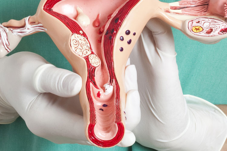 cervical cancer