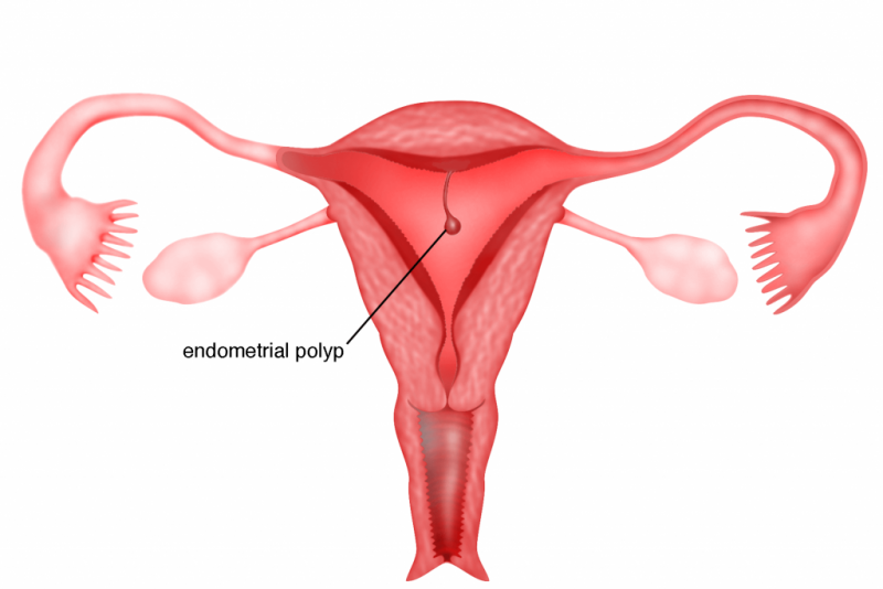 Endometrial-polyp