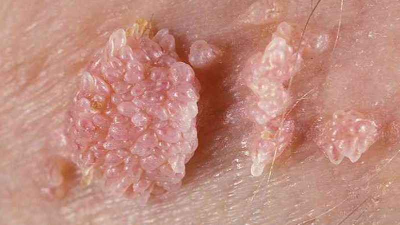 HPV Signs Symptoms