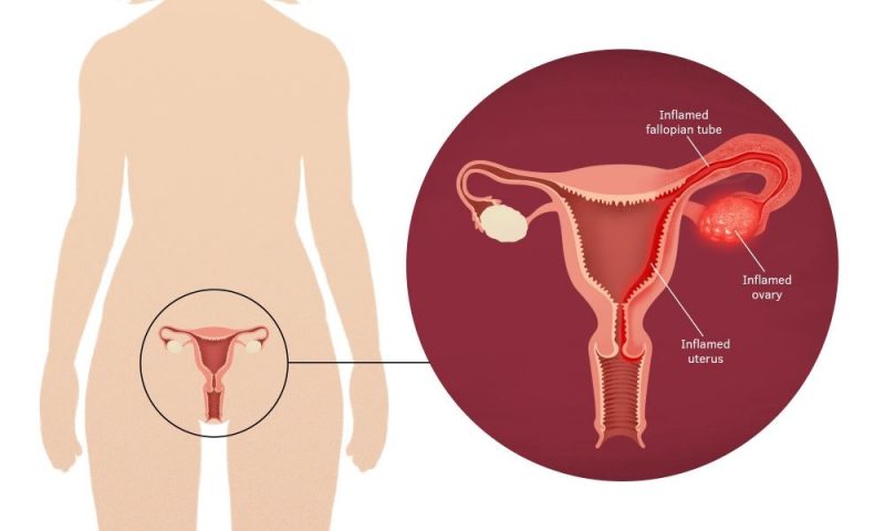 Pelvic inflammatory disease