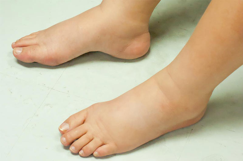 اگر علت ورم پا احتباس مایعات در بدن باشد، می‌توان با هیدروکلروتیازید از میزان مایعات اضافی بدن کاست.