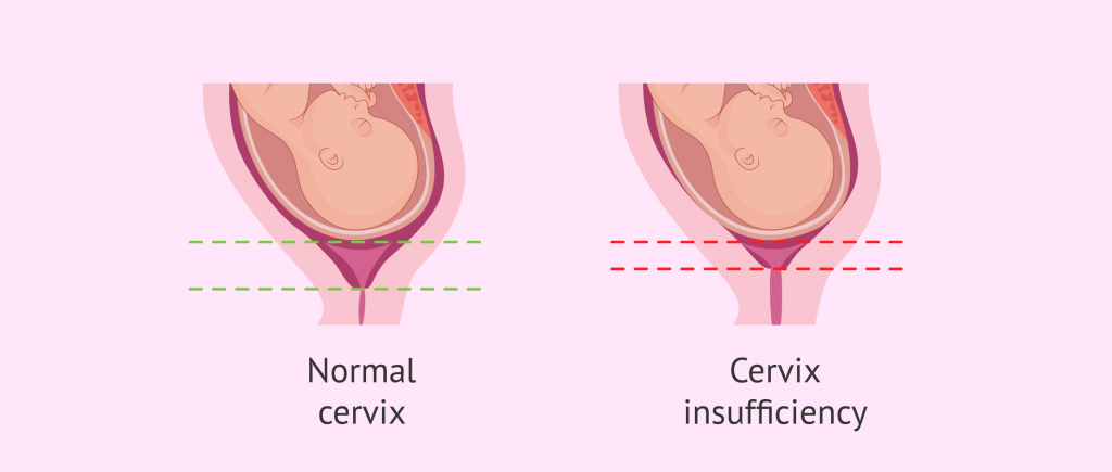 cervix insufficiency