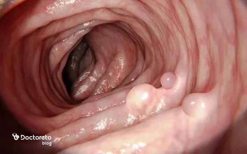 عکس پولیپ معده