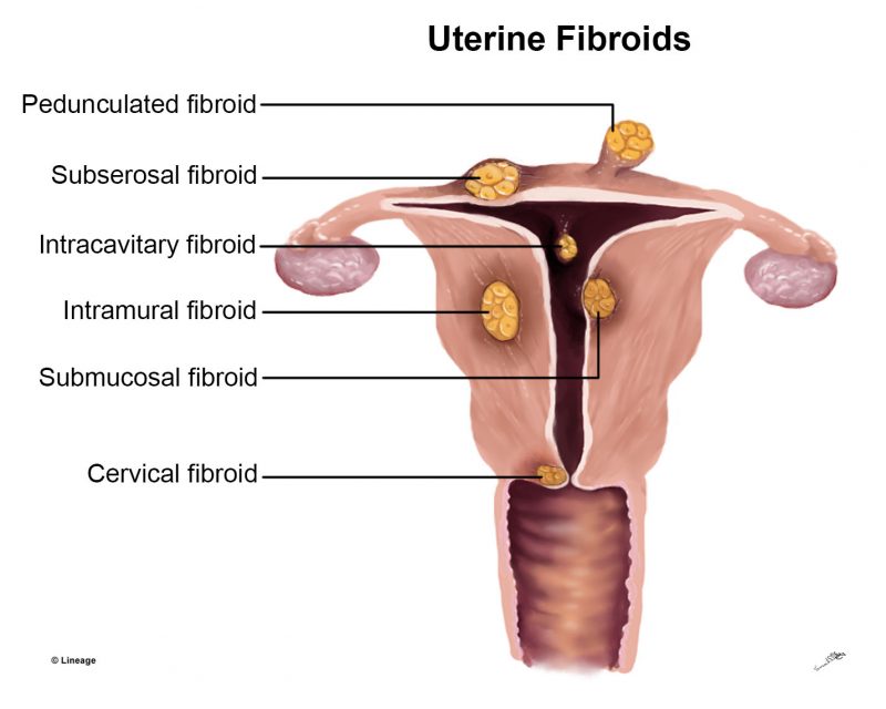 cervical fibroma
