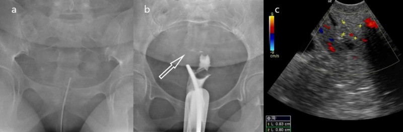 endometrial polyps treatment by hysteroscopy