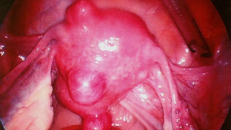 fibroids in uterus
