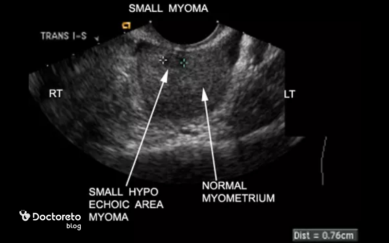 عکس فیبروم رحم در سونوگرافی چه شکلی است؟