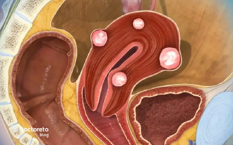 فیبروم رحم چیست؟
