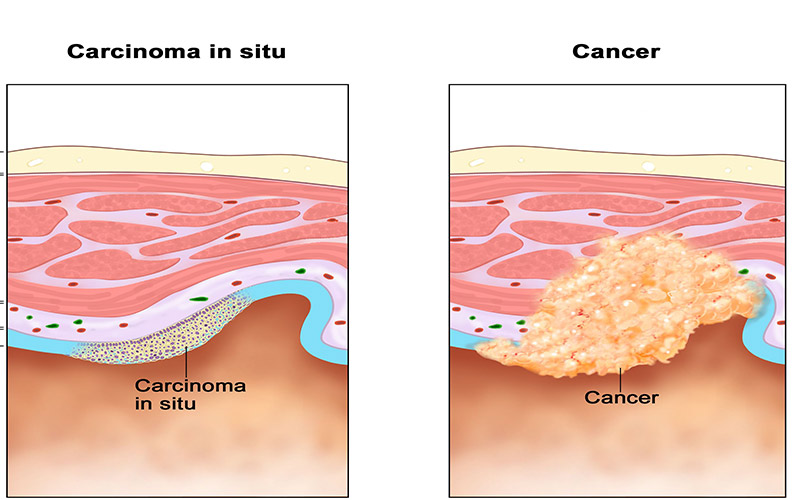 سرطان کارسینوما