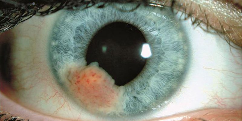 بیماری سرطان چشم