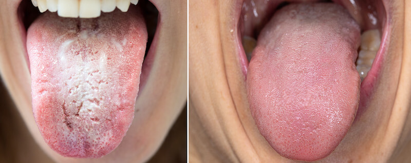 آفت دهانی در زبان، سمت چپ زبان دارای برفک دهانی، سمت راست زبان سالم