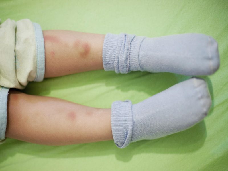 علائم سرطان خون در کودکان و کبودی