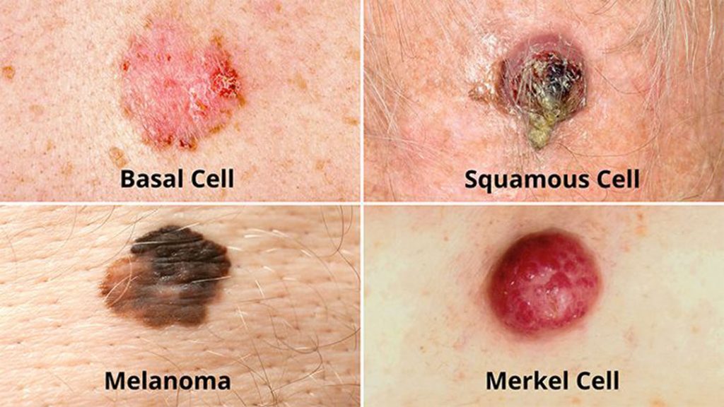 انواع سرطان پوست در یک تصویر