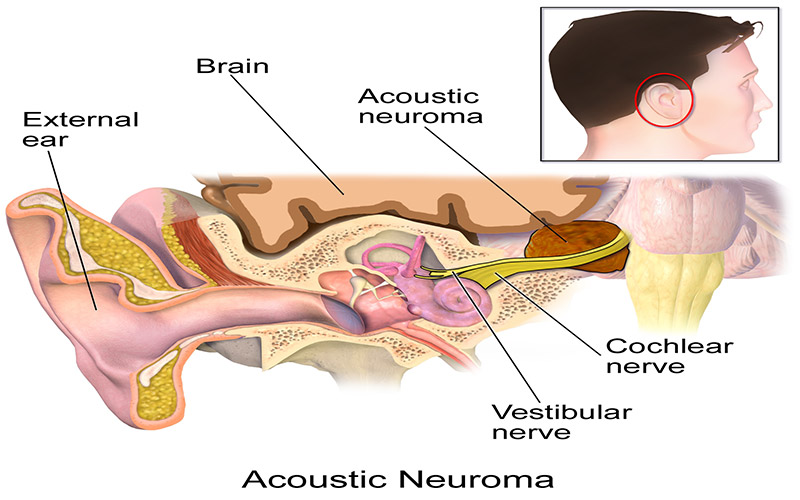 در این تصویر می‌توانید تومور آکوستیک نوروما را در قسمت عصب شنوایی مشاهده کنید.