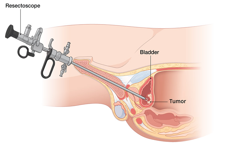 از ابزار سیستوسکوپ هم برای تشخیص سرطان و هم برای برداشتن تومور از مثانه استفاده می‌شود. 
