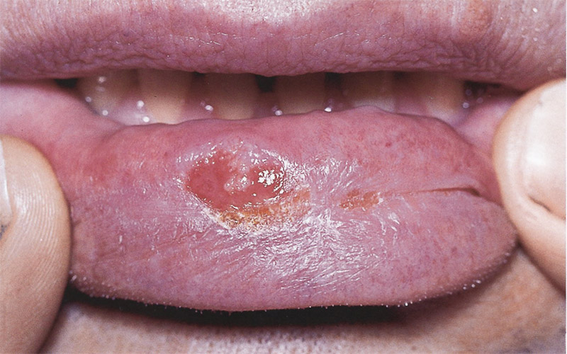 در این تصویر زخم ناشی از سرطان سلول سنگ فرشی را در دهان مشاهده می‌کنید.