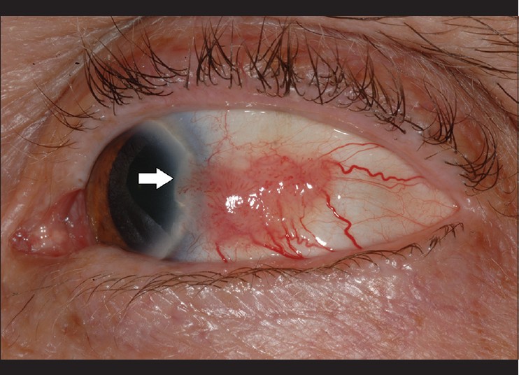 تومورهای بدخیم ملتحمه چشم