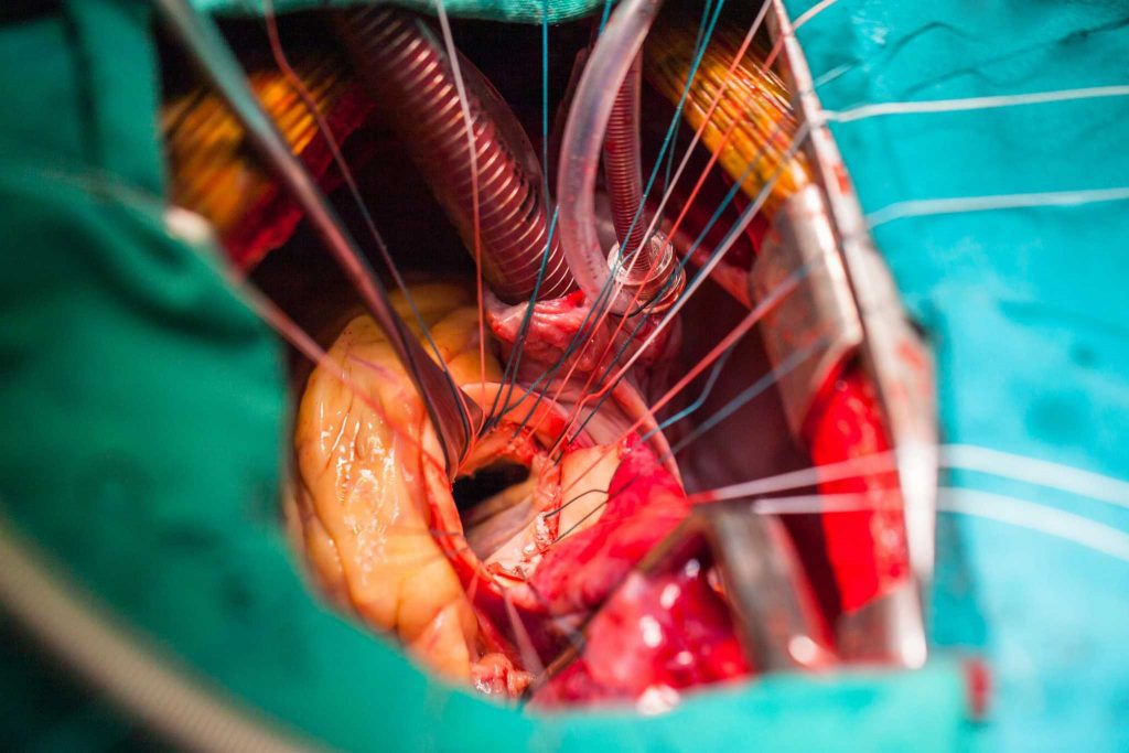 عمل قلب باز برای تعمیر یا تعویض دریچه میترال