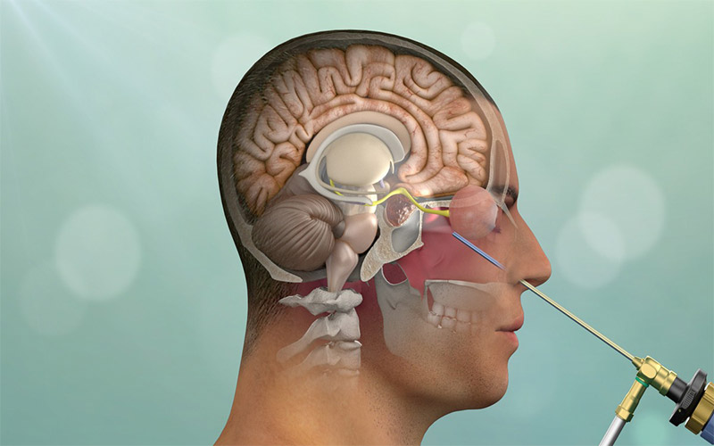 اگر تومورهای هیپوفیز کوچک باشند، با جراحی از طریق بینی می‌توان بدون برش خارجی آن را خارج کرد. 