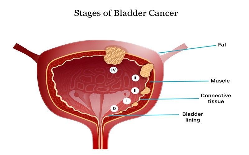  سرطان مثانه گرید ۴ کل مثانه را درگیر کرده و به بافت‌های مجاور سرایت می‌کند. 