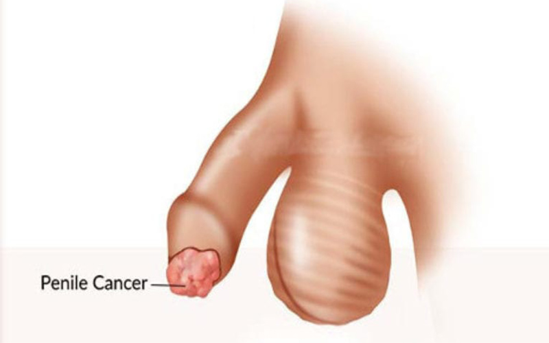 یکی از علائم اصلی تومور آلت تناسلی ایجاد زخم یا توده روی آلت تناسلی است.