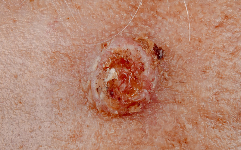 در این تصویر می‌توانید سرطان سلول سنگفرشی پوست را مشاهده کنید.