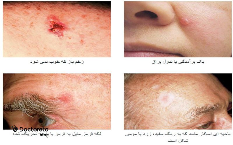 عکس سرطان سلول بازال روی صورت
